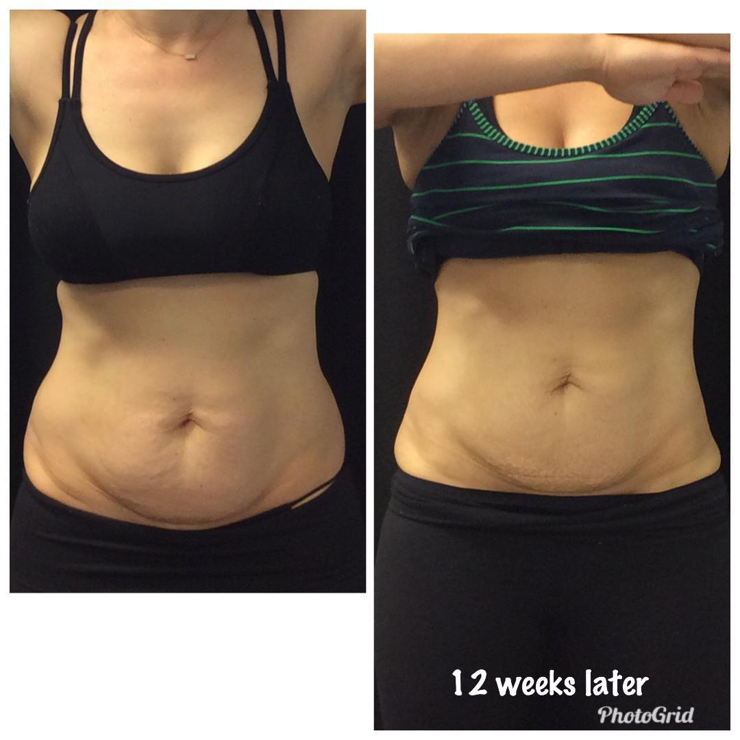 Coolsculpting Before/After 1