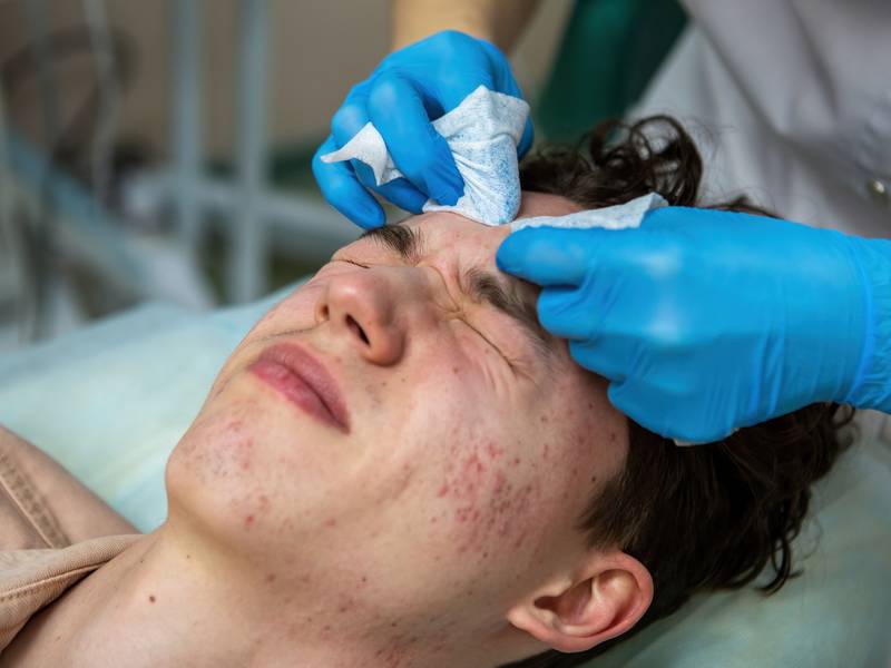 Can Acne Treatment Eliminate Stubborn Pimples?