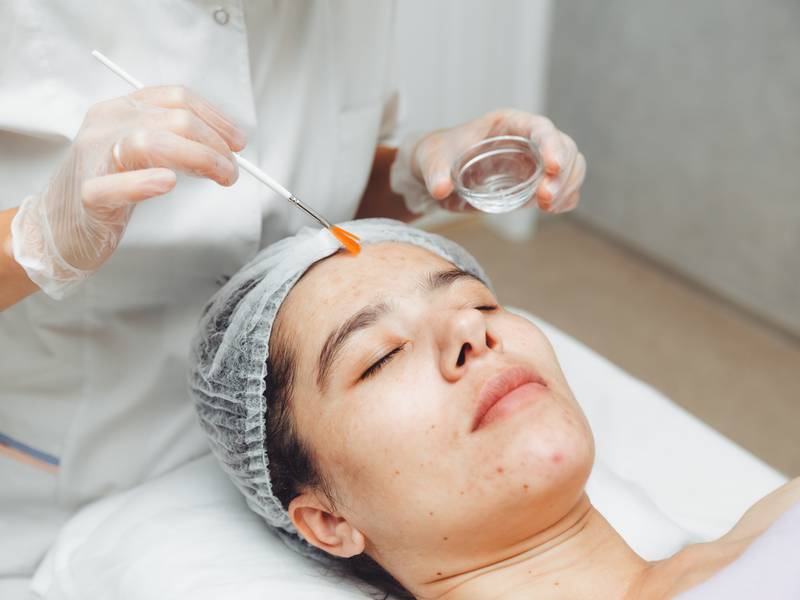 How Long Does Acne Treatment Take to Show Results?