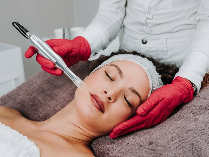 What Is Microneedling?