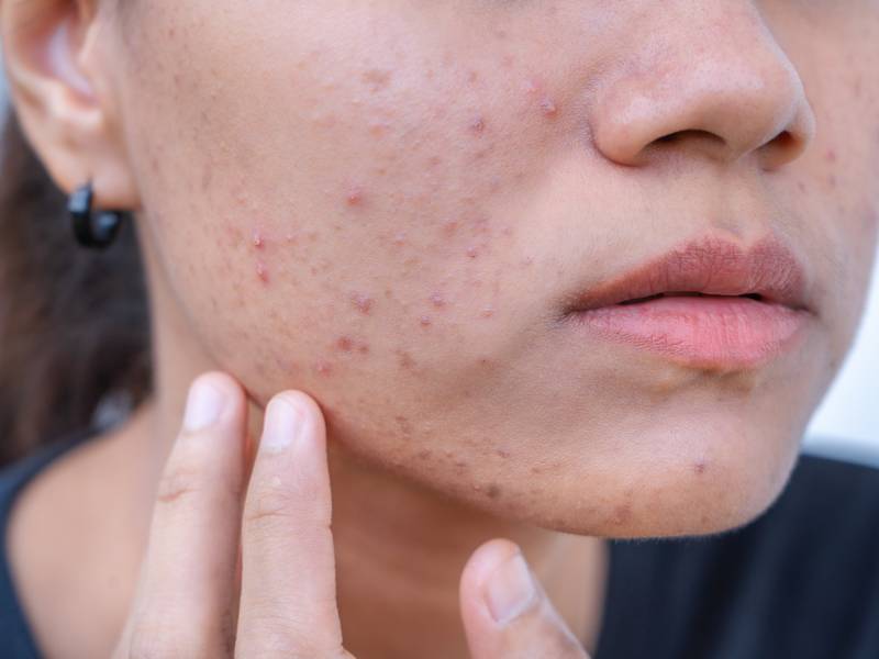 Why Should I Consider Acne Treatment?