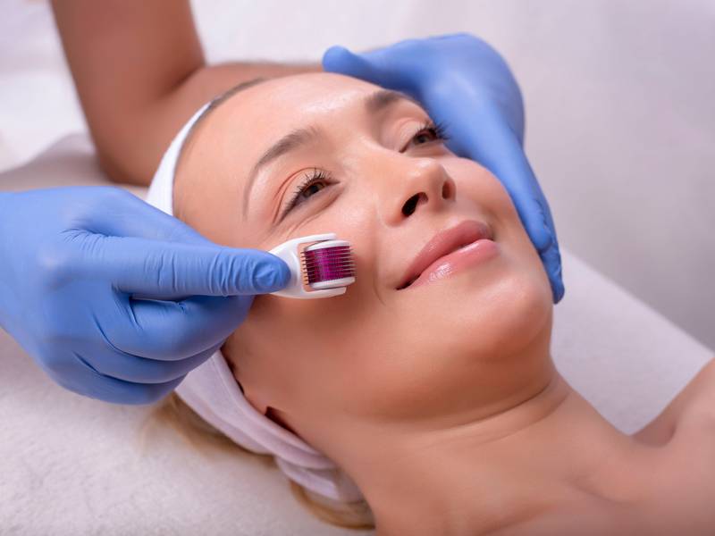 How Does Microneedling Help Improve My Skin’s Appearance?
