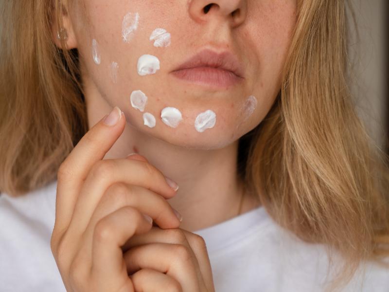 Where Can I Get Acne Treatment in Plymouth, MI?