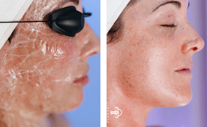 Chemical Peels - Before & After