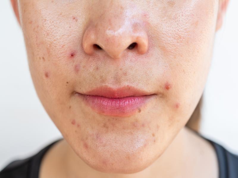 What Do I Need to Know about Getting Acne Treatment Near Canton, MI?