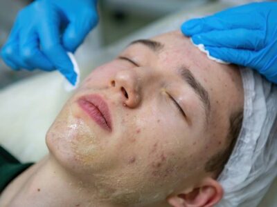 What is the Best Acne Treatment For Aggravated Skin?